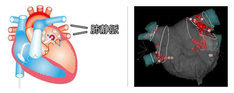 アブレーション カテーテル