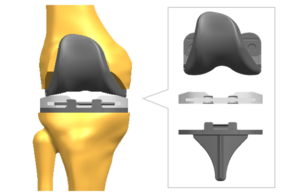 術 関節 人工 膝 置換 人工膝関節置換術(TKA)の術後の痛みについて~痛みの原因と痛みを感じる時期について~