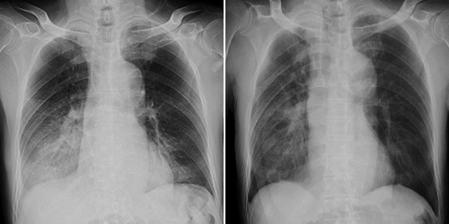 レントゲン 肺炎