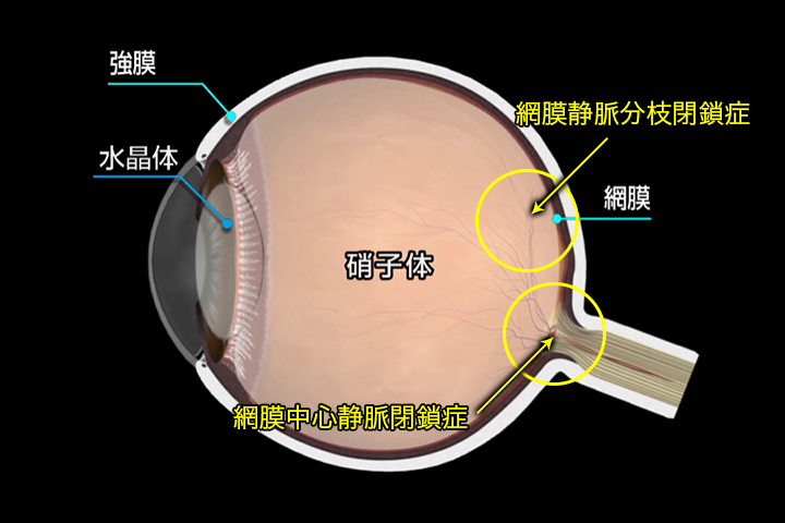 中心 静脈 症 網膜 閉塞